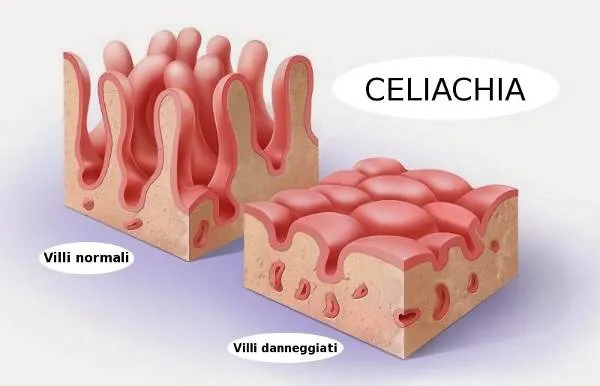 celiachia villi