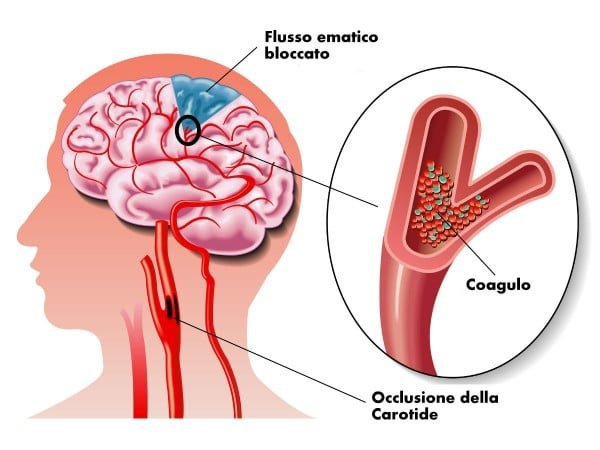 malattie cardiovascolari