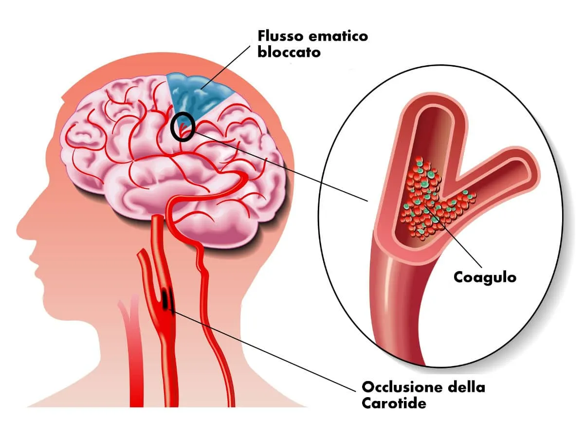 malattie cardiovascolari