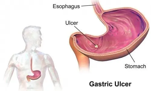 cosa sono gastrite ed ulcera
